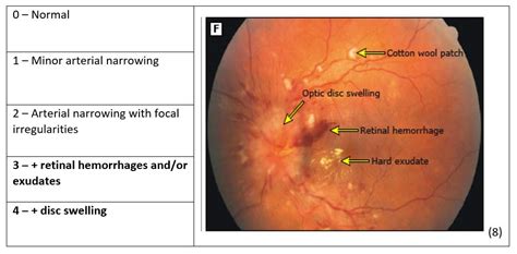 fundoscopy findings|fundoscopic findings in hypertension.